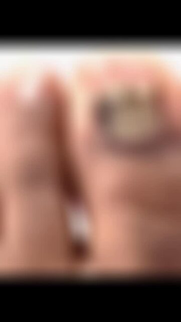 Toenail Restoration the two great toes! #medicalnailtech #healthyfeet #detroit #waterlesspedicure #podiatry