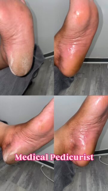 Medical Pedicurist I specialize in Diabetic foot care, medical pedicures, cracked heels 

BOOK TODAY!
https://square.site/book/L5Y9E4CJ05MSF/honee-pa-leeze-southfield-mi

#diabeticfootcare #diabetic #medicalpedicure #medicalnailtech #heappyfeet #paraffintreatment #waterlesspedicure #feetgram #detroit #healthyfeet